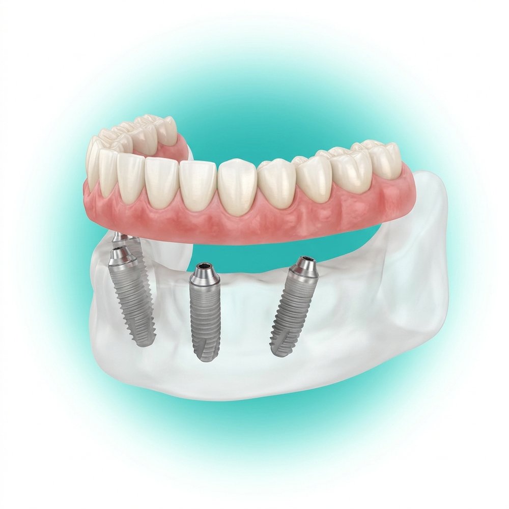 Sistema All-on-4 com 4 implantes e prótese fixa de arcada total